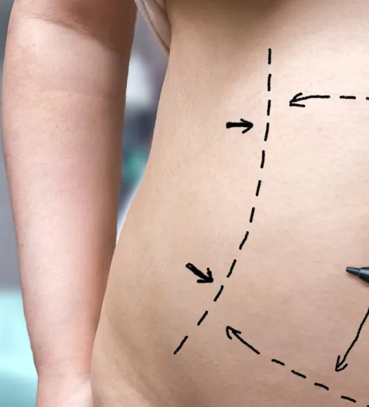 Last van een hangbuik? Met een buikwandcorrectie kan dit gecorrigeerd worden - in te plannen bij de Helene Schweitzer kliniek.