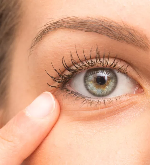 Verslapping van de huid onderooglid - te verhelpen met een onderooglidcorrectie bij de Helene Schweitzer kliniek.