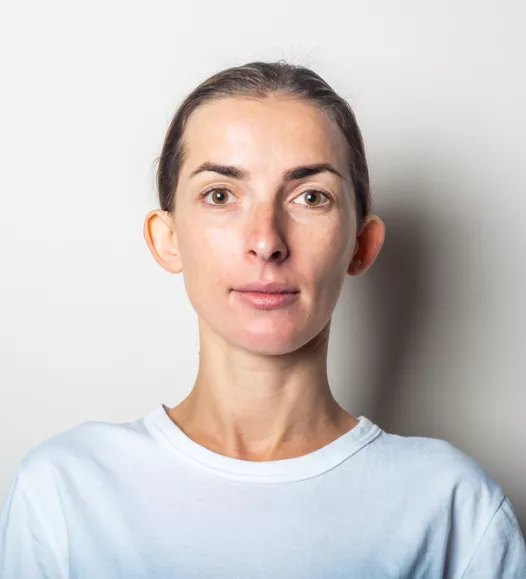 Vrouw met flaporen - te verhelpen met een oorcorrectie bij de Helene Schweitzer kliniek.
