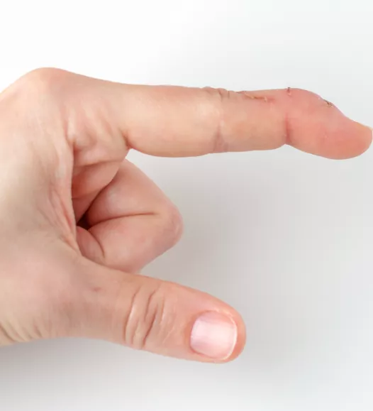Hamervinger, pijnlijk en gezwollen vinger. Te behandelen bij de Helene Schweitzer kliniek.