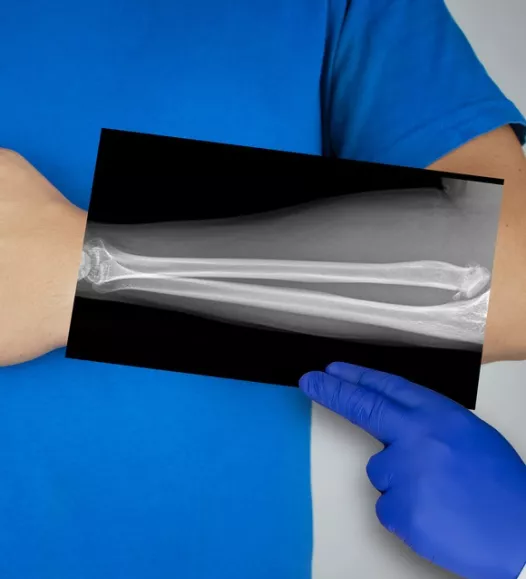 Persoon met lange ellepijp. Inkorten van de ellepijp kan bij de Helene Schweitzer kliniek.