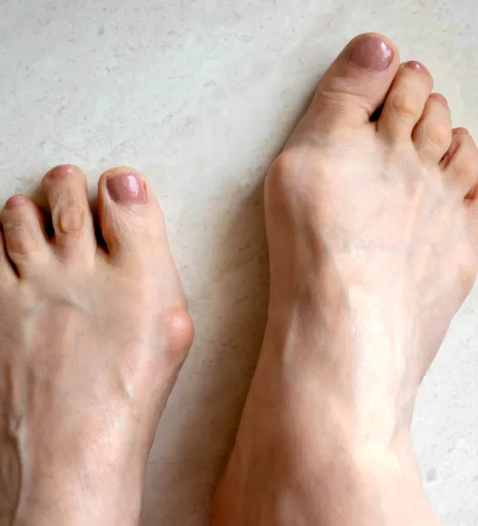Hallux valgus (knobbelteen) - scheve grote teen. Te behandelen bij de Helene Schweitzer kliniek.