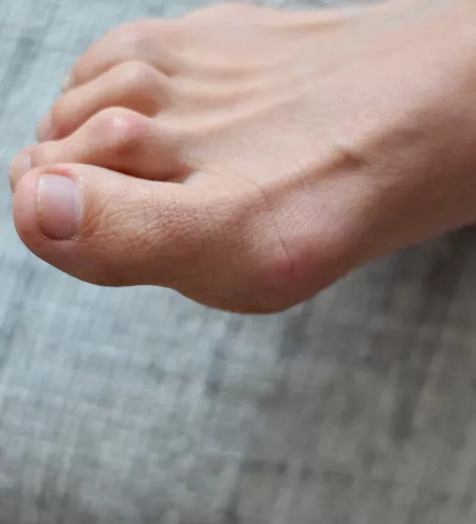 Hamerteen - tenen in gebogen positie. Te behandelen bij de Helene Schweitzer kliniek.