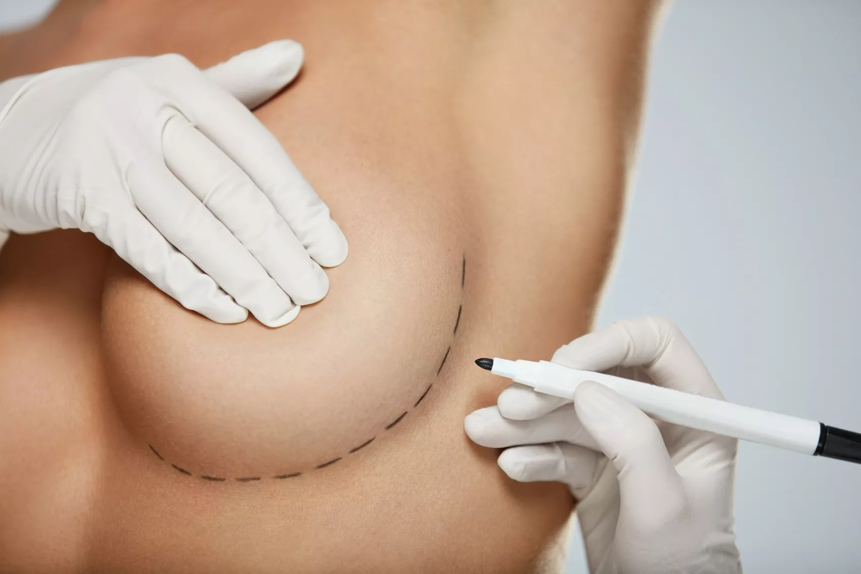 Borstcorrecties behandelingen bij de Helene Schweitzer kliniek. Borstvergroting, borstlift, borstverkleining.