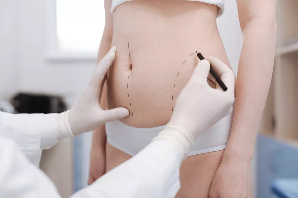 Abnormale vethoping? Met een liposuctie bij de Helene Schweitzer kliniek kan dit behandeld worden.